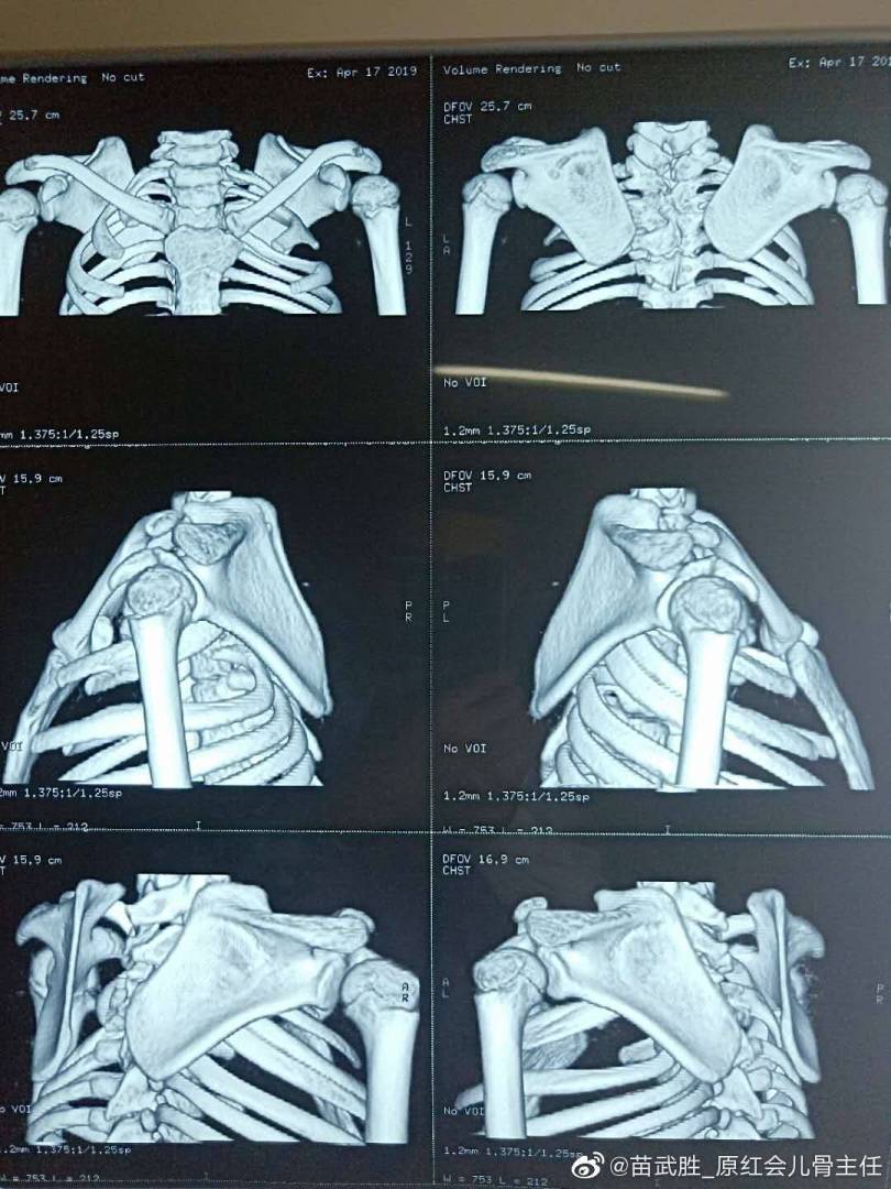 近期做的先天性高肩胛术前术后照片