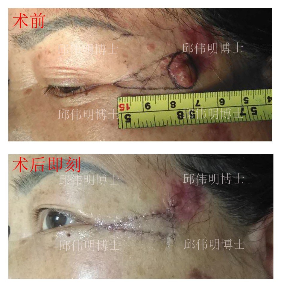v-y岛状皮瓣术用于肿物切除后的缺损