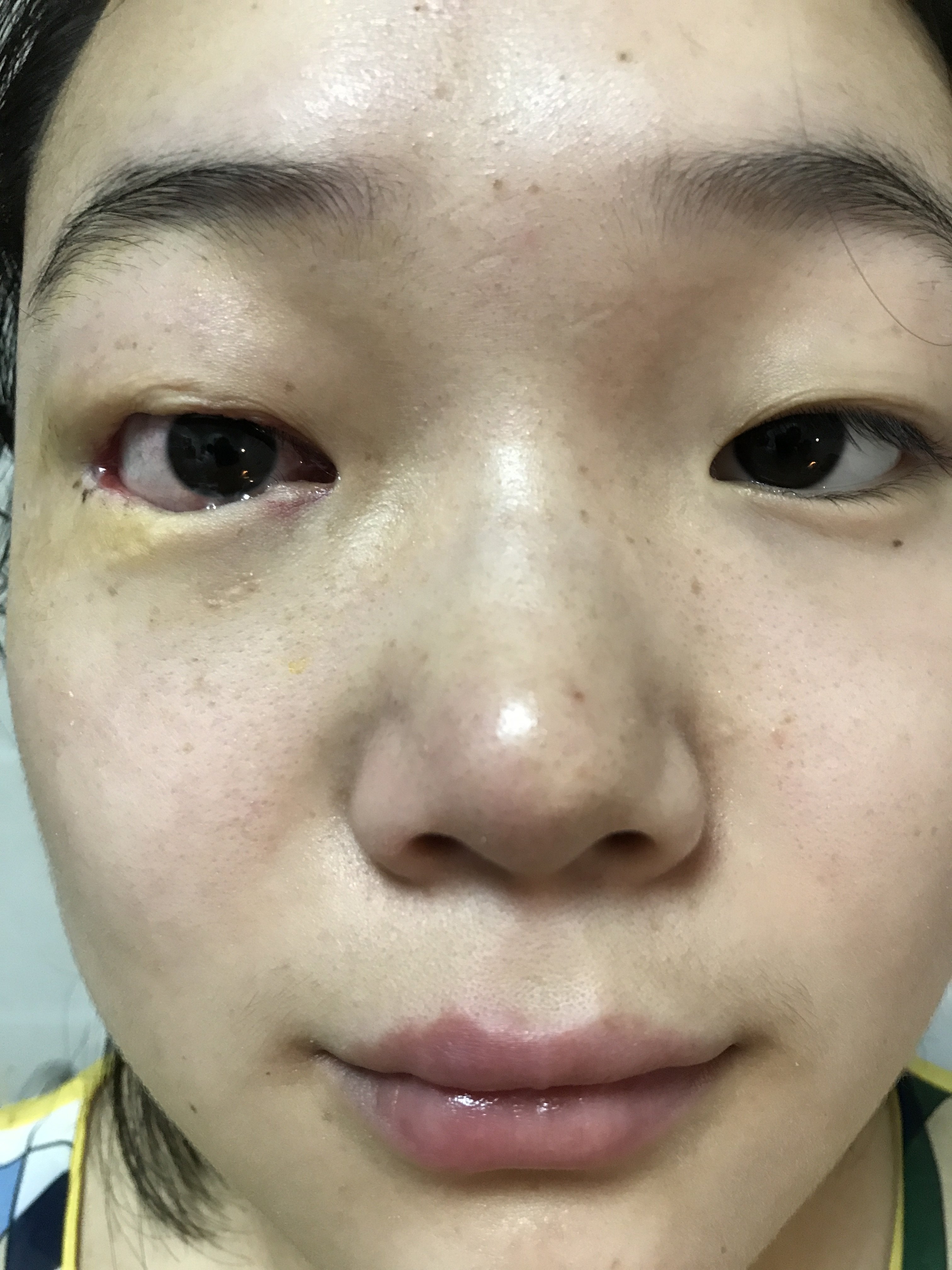 河南省直第三人民医院 刘现忠 文章列表 >巨大分裂痣手术(医者版)