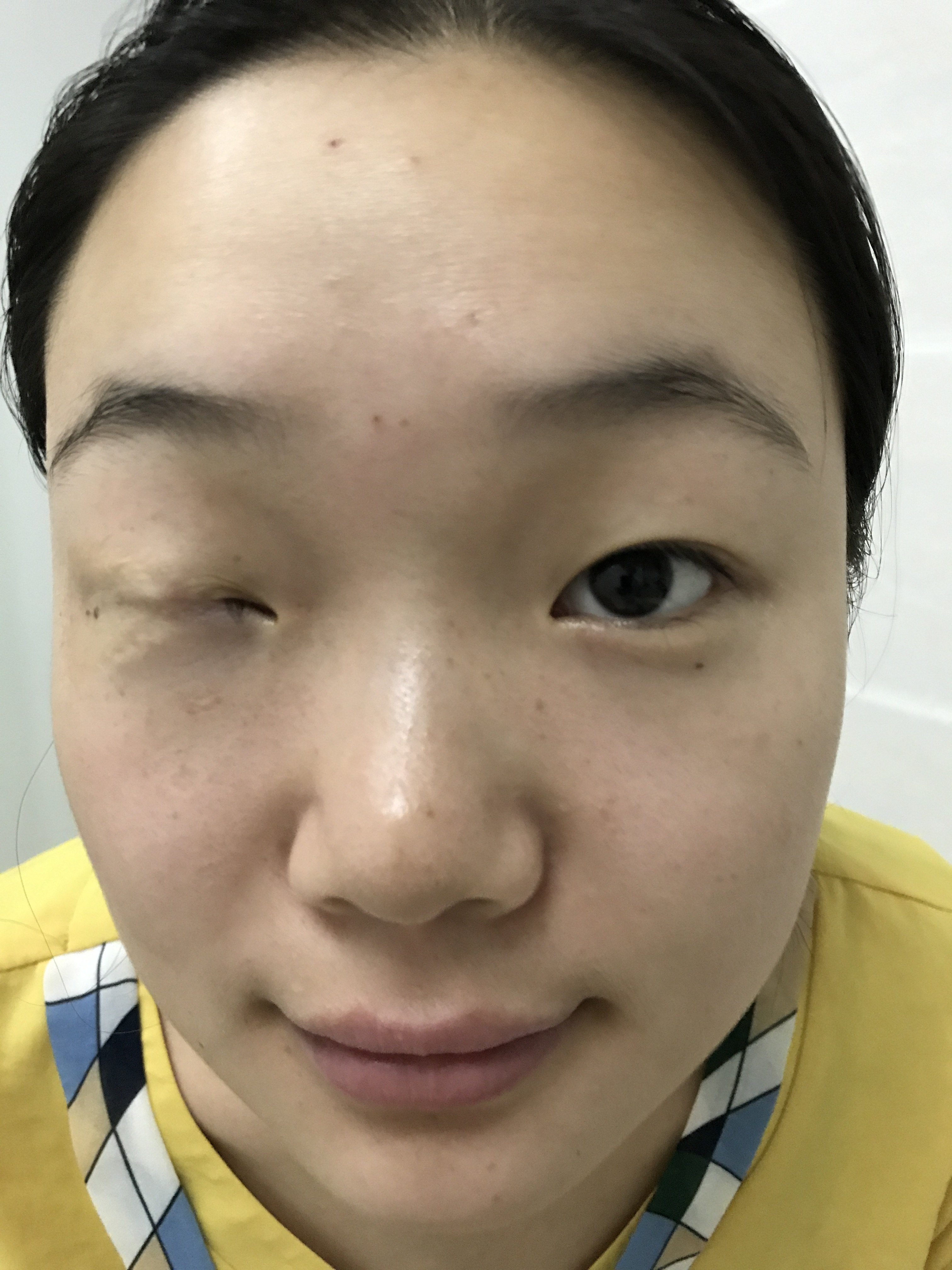 巨大分裂痣手术(医者版)