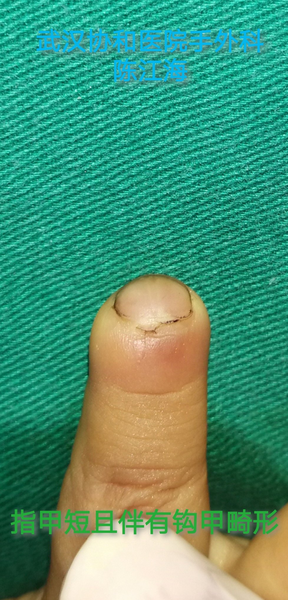 幼儿手指末节部分缺损后矫形术