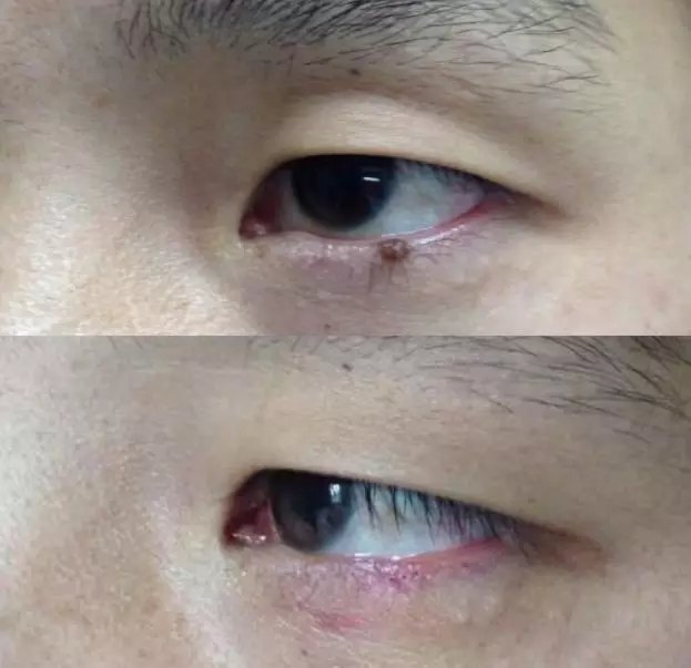 图三 下眼睑色素痣切除效果