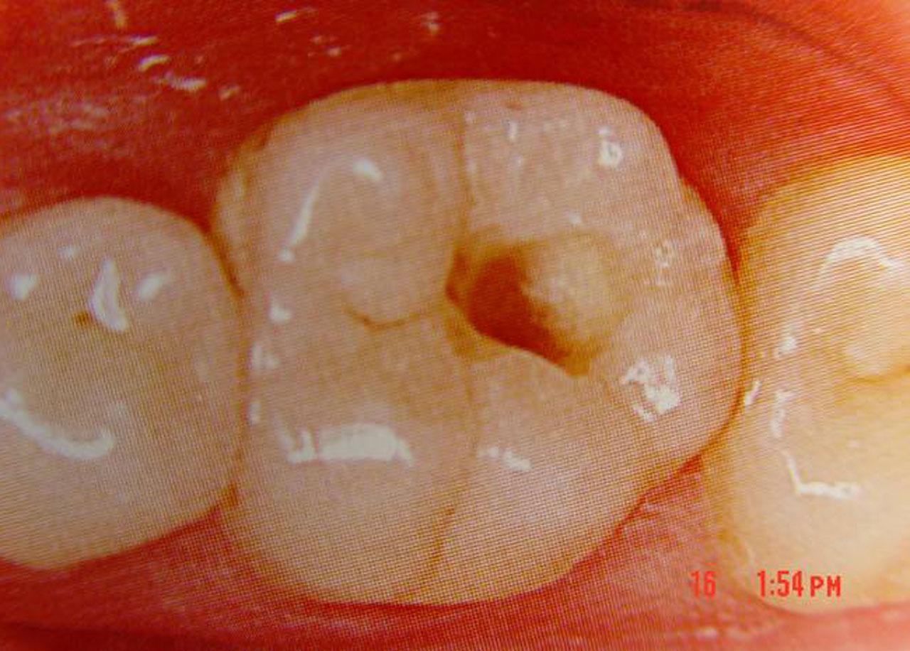 牙齿里面真的会有虫吗?