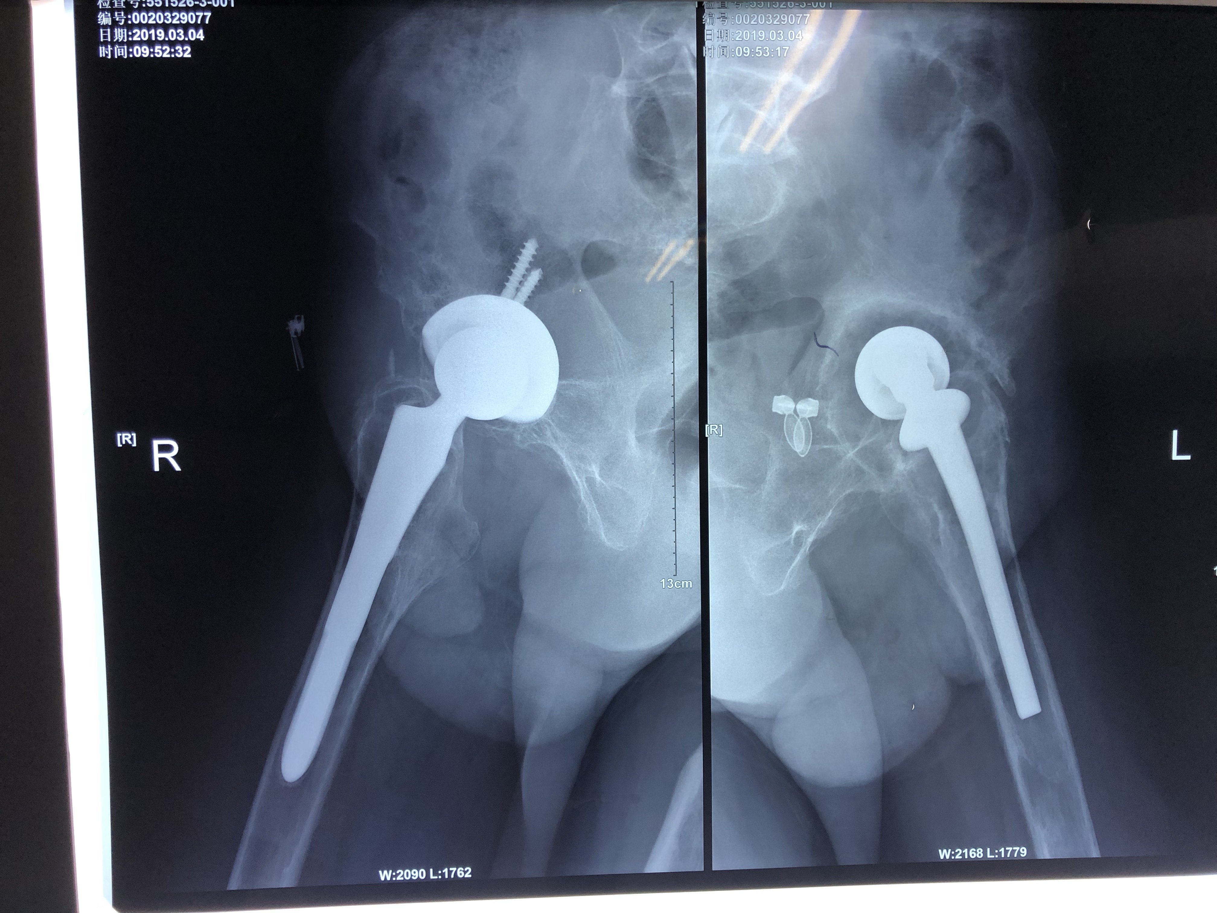 >21年的老关节假体翻修   73岁老人,21年前行双侧髋关节置换,左侧双极