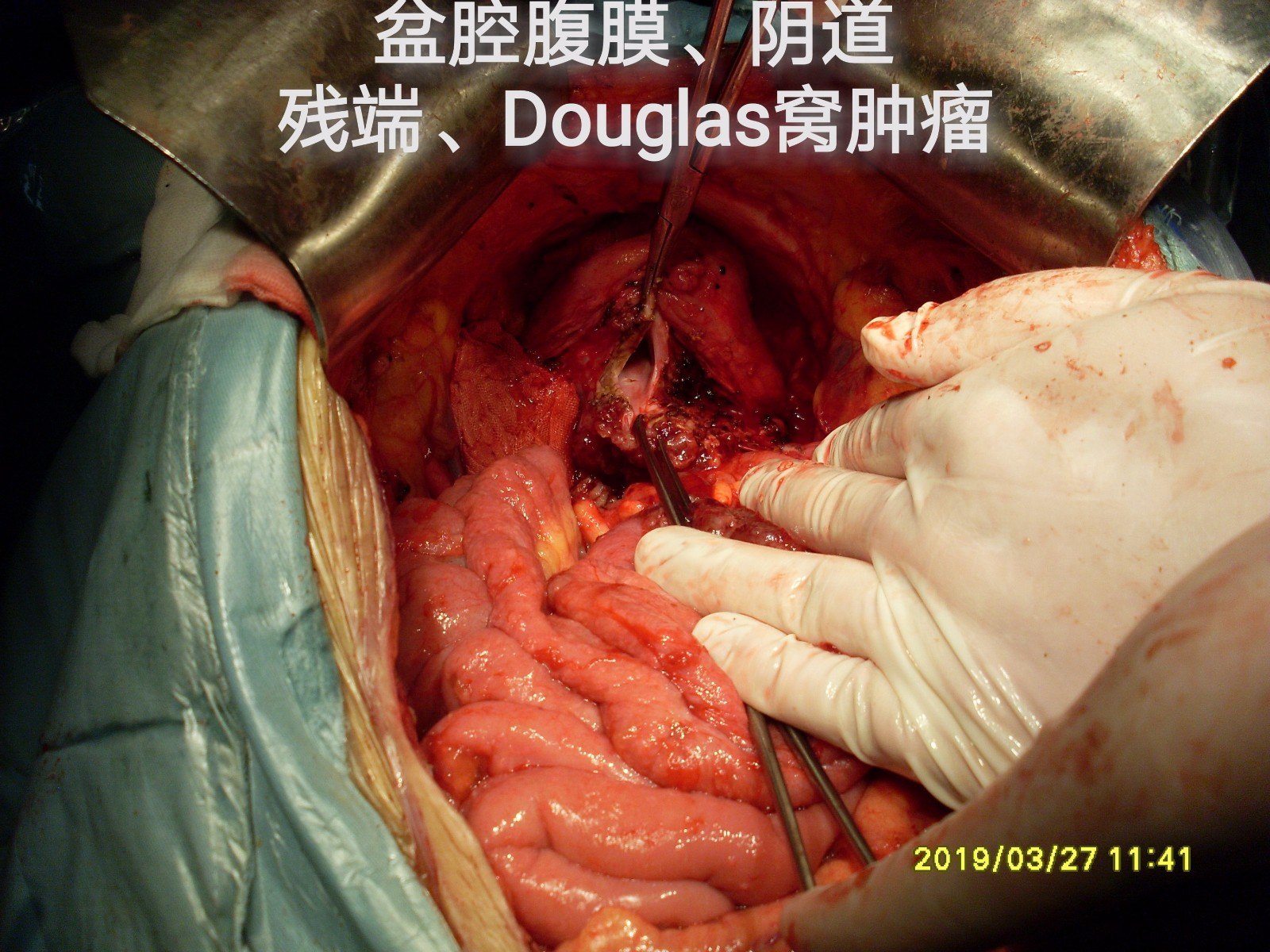 病例(32-卵巢囊肿实为阑尾粘液性肿瘤9 手术实施方案:双侧腹膜,盆腔