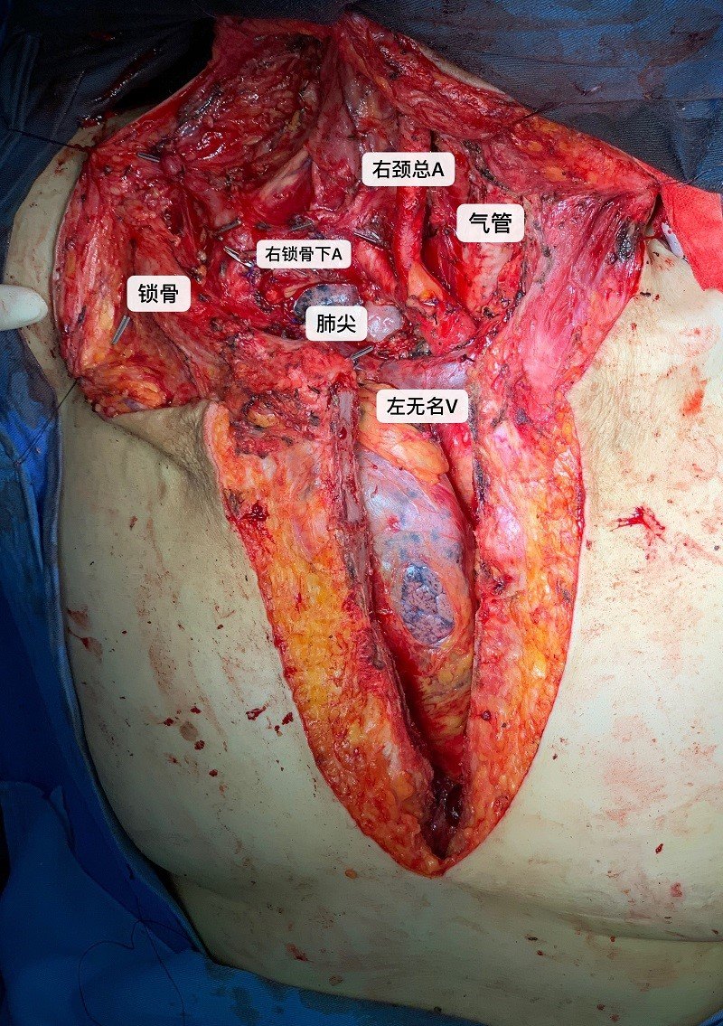 图四:肿瘤切除后的创面,颈胸部的重要结构几乎解剖殆尽