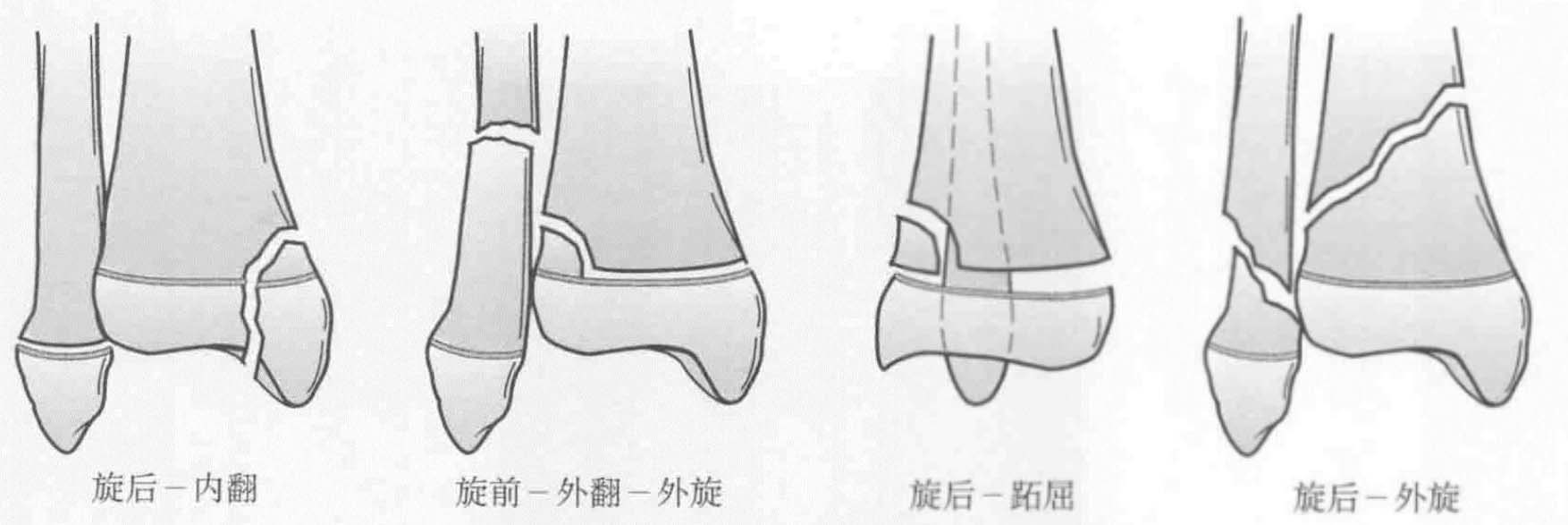 足的位置及损伤的外力特点,dias及tachdjian将其分为四个类型①旋后