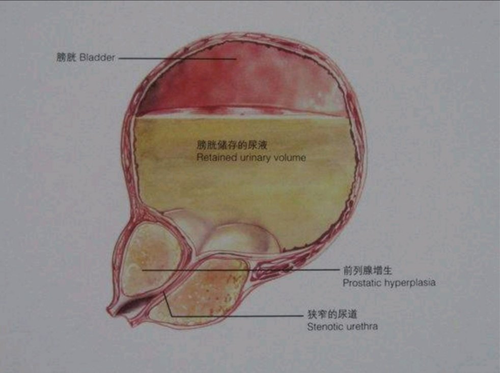 前列腺增生排尿困难尿线变细分叉排尿等待尿频尿失禁血尿等