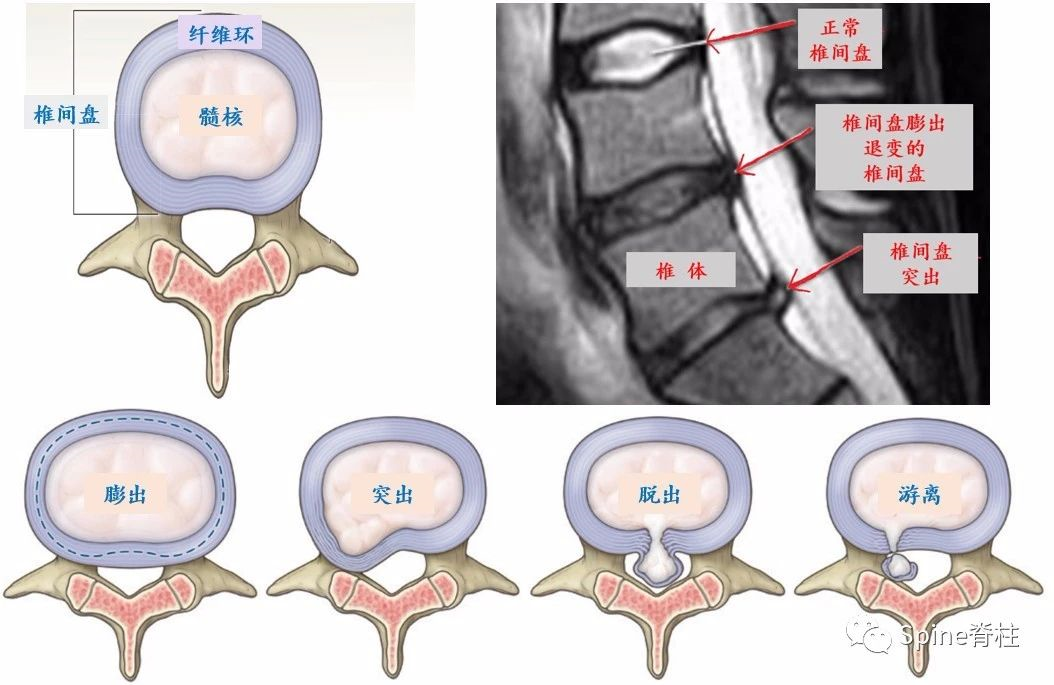 图6a:不同类型的腰椎间盘突出
