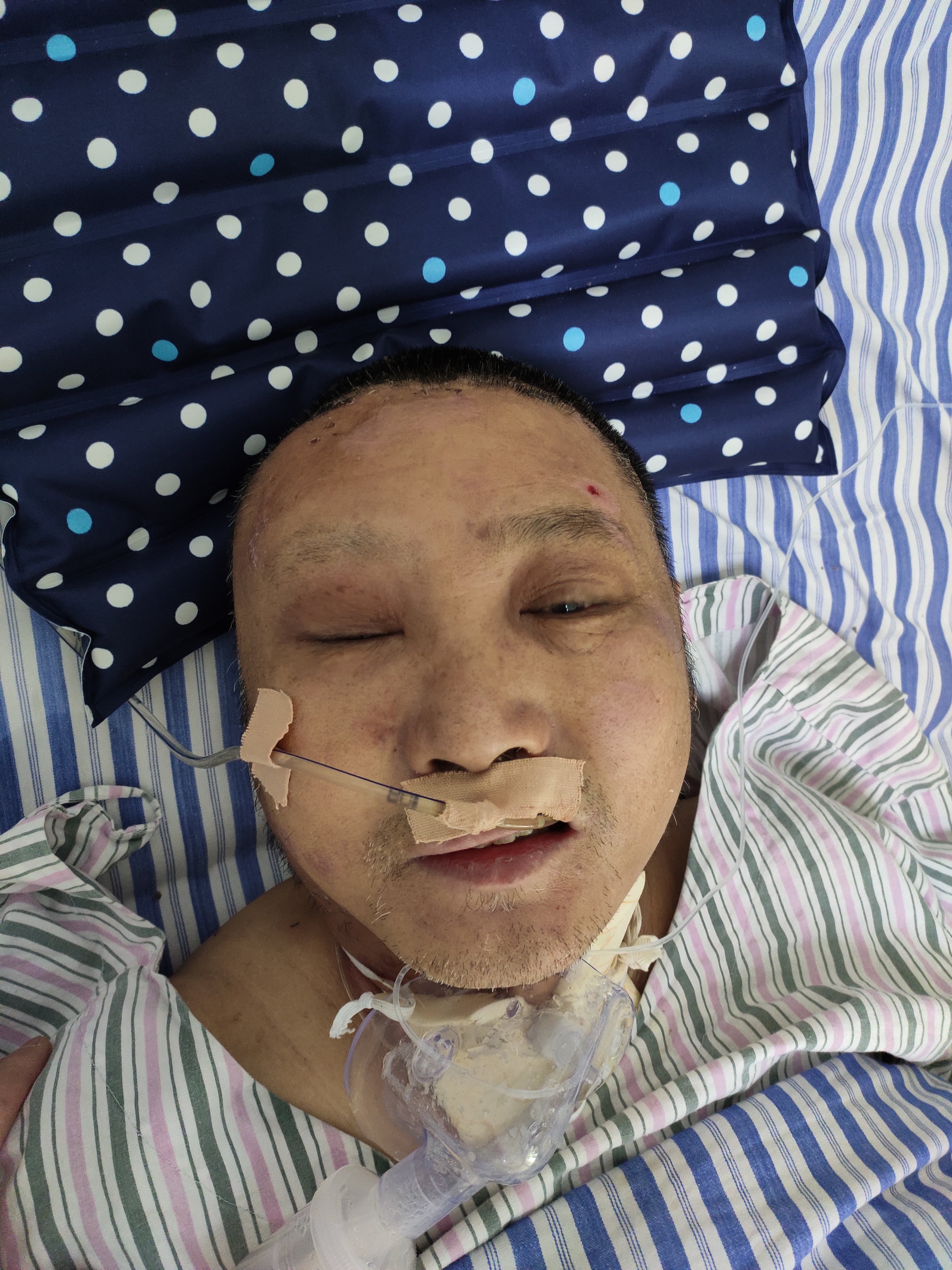 脑挫伤颅底粉碎性骨折脑脊液漏