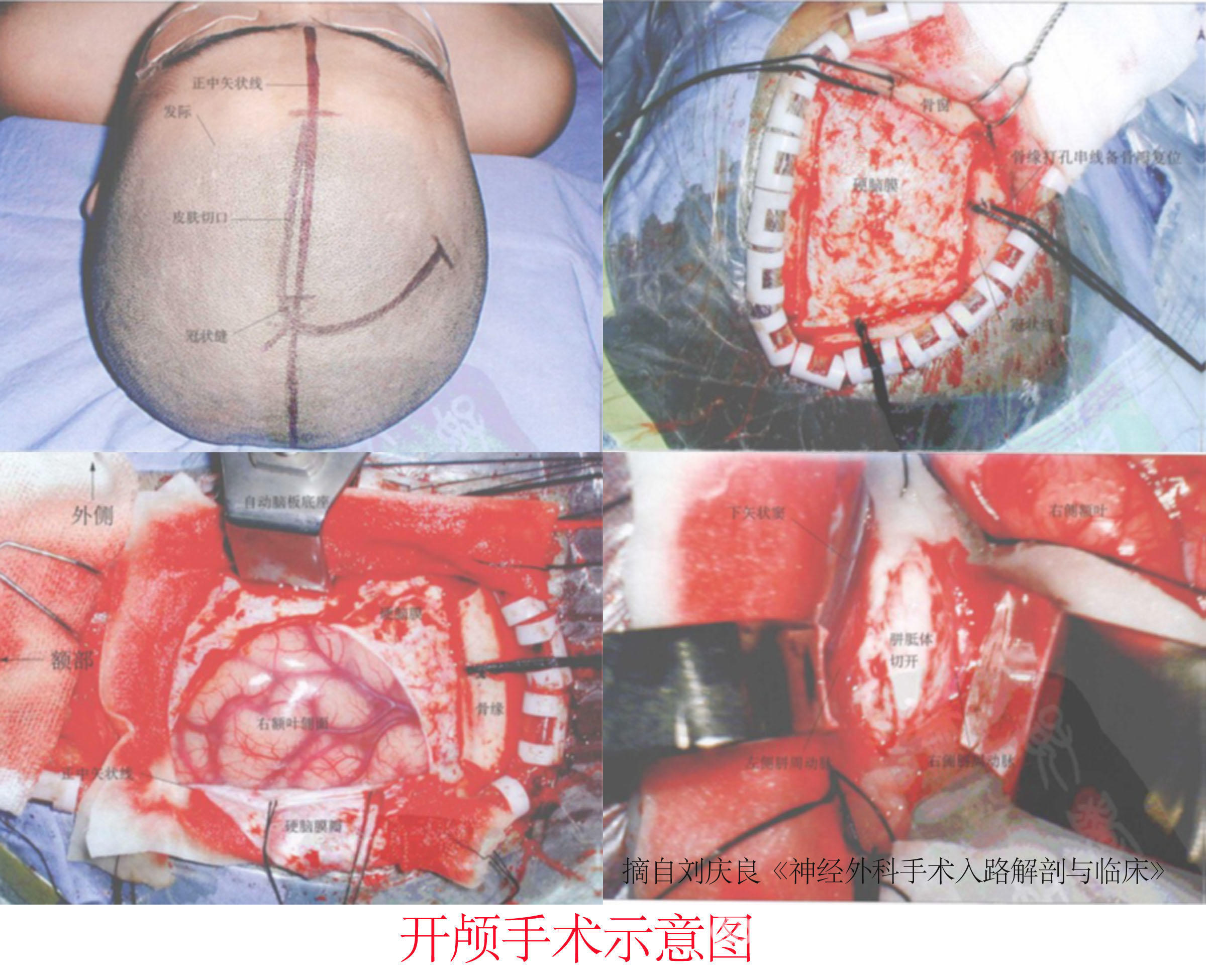脑积水治疗的新方法