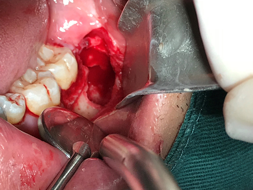 (上篇) 超声骨刀辅助下 拔牙 ,从创口可以可以看到下牙槽神经管的轮廓