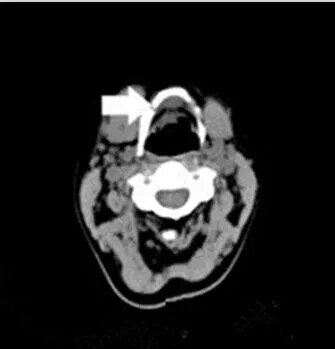 患者误以为是"甲状腺肿物"ct下可见颈正中舌骨与甲状软骨间见3×3×2