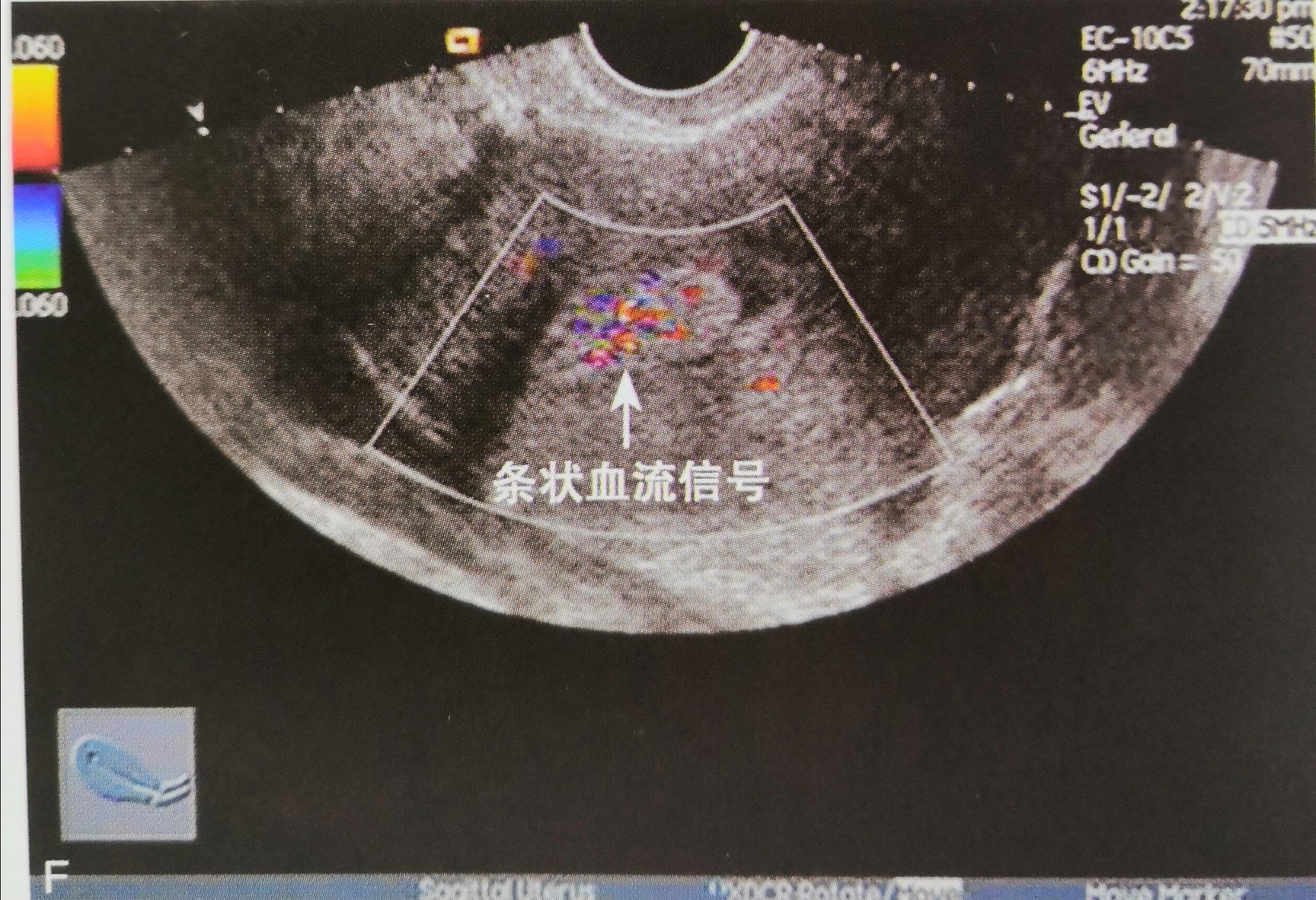 子宫内膜息肉