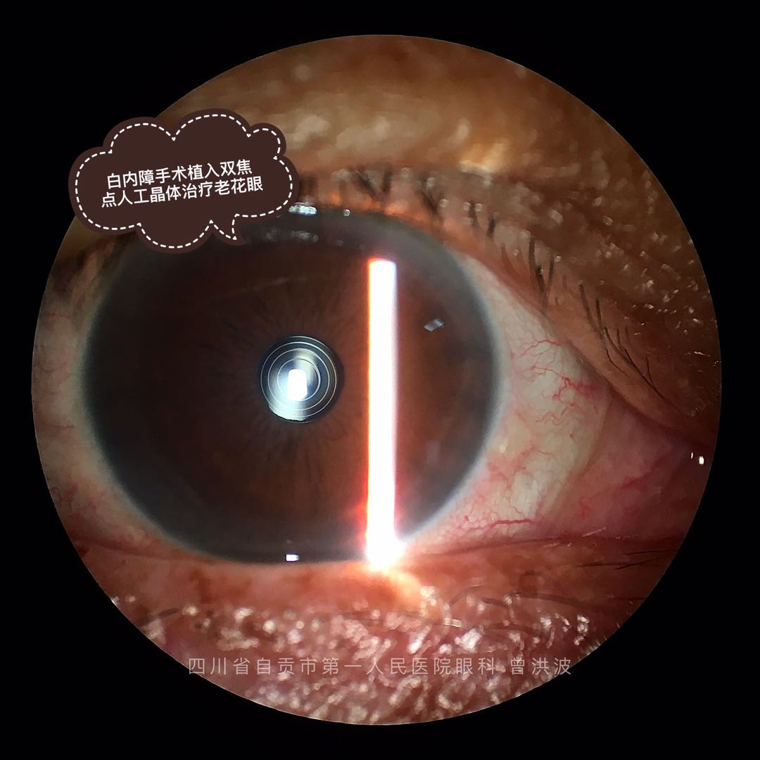 今天,我们来看看屈光性 白内障 手术植入的高端人工晶体在眼睛里面是