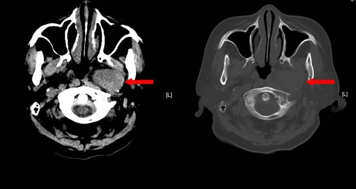 ct平扫显示肿物位于左侧咽旁间隙(左为软组织窗,右为骨窗)