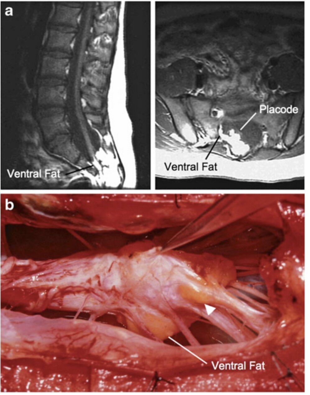 复杂的脂肪瘤型脊髓拴系综合征如何治疗手术病例文献回顾