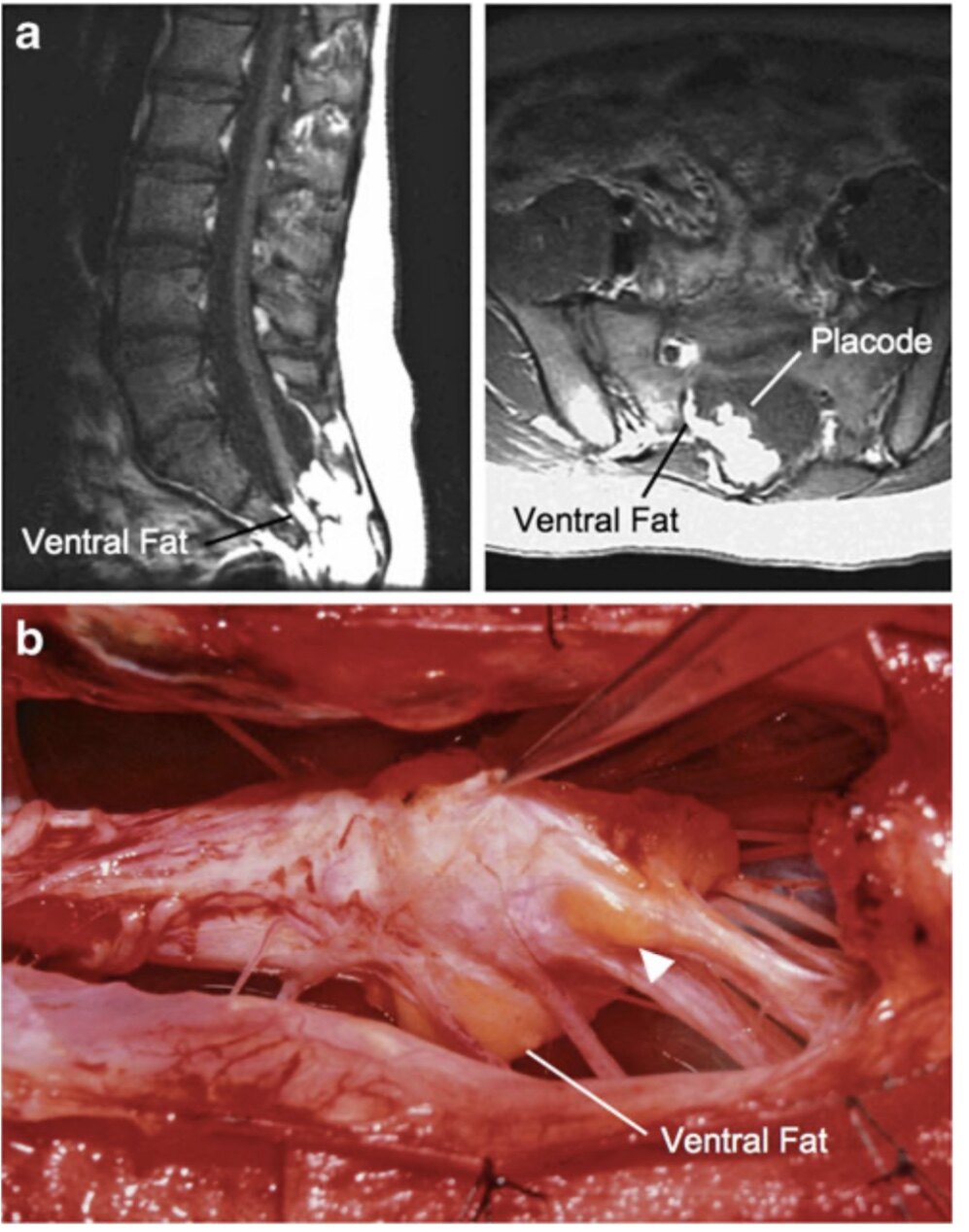 复杂的脂肪瘤型脊髓拴系综合征如何治疗?(手术病例 文献回顾)