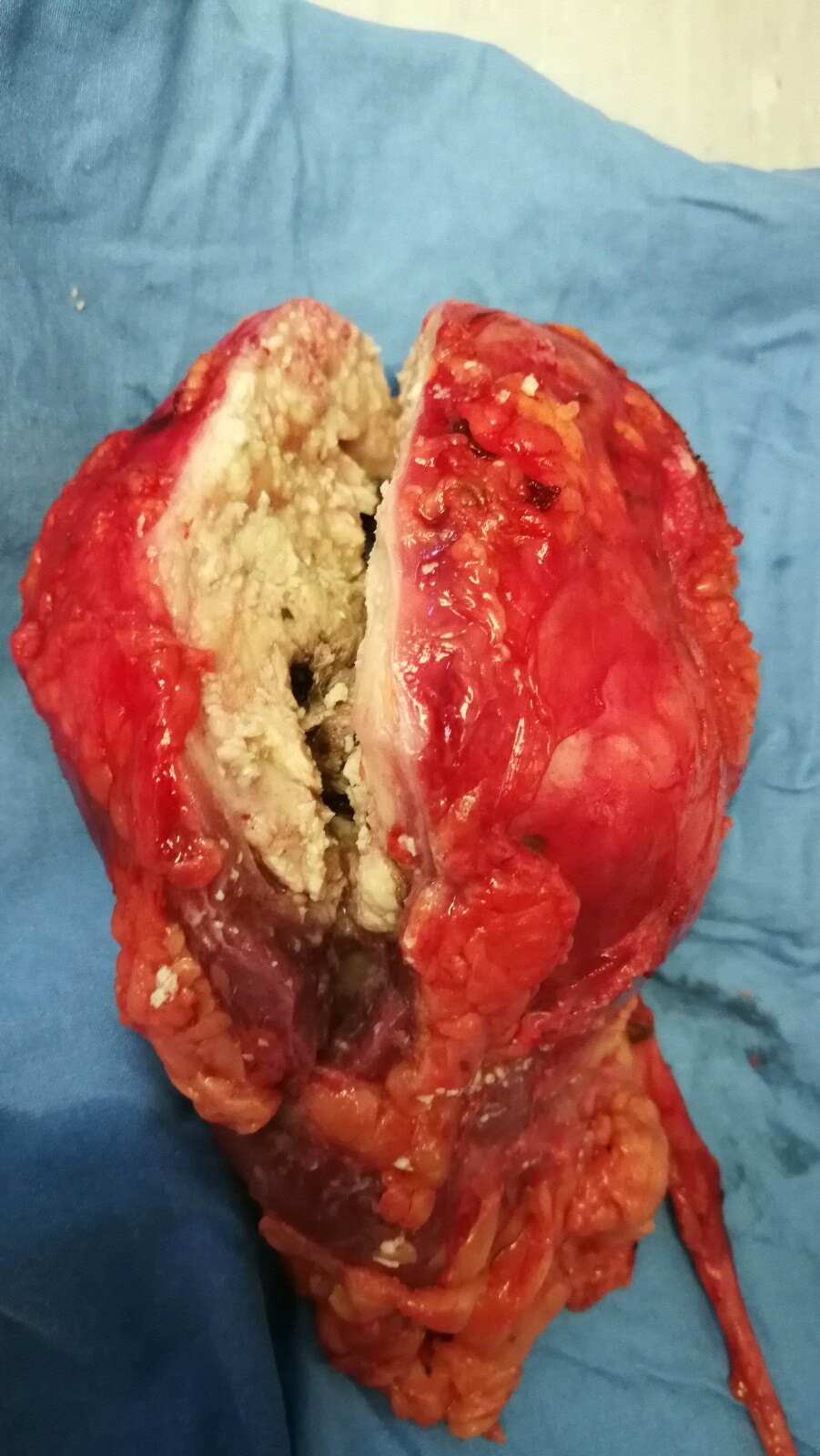 我的手术案例十:肾盂鳞癌伴急性脑出血恢复期行开放半尿路切除术