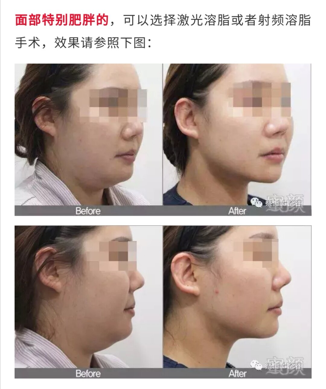 面部轮廓整形之下颌缘