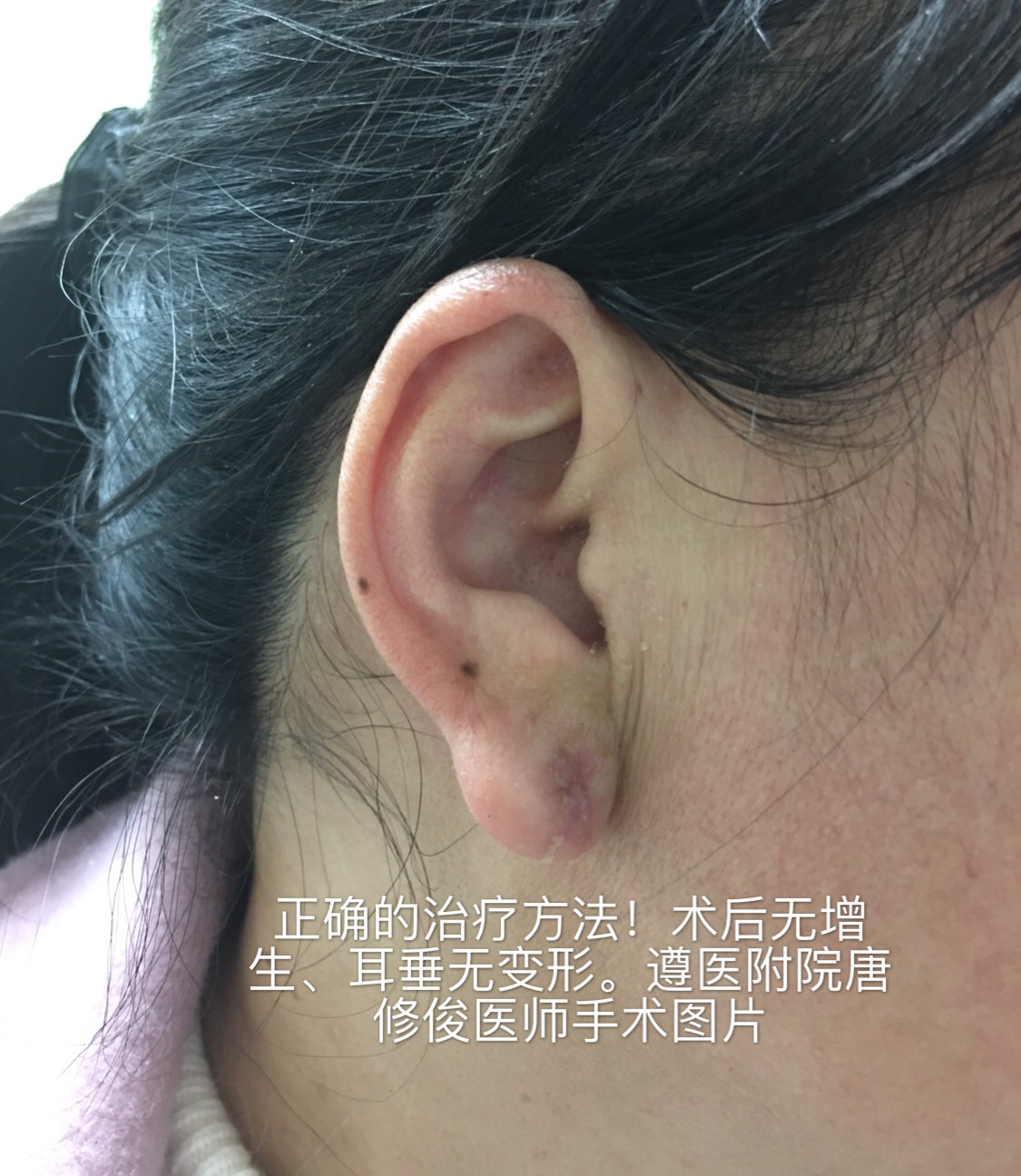 手术一定不能破坏瘢痕外皮,内核要切除干净,不能破坏耳朵亚单位,及
