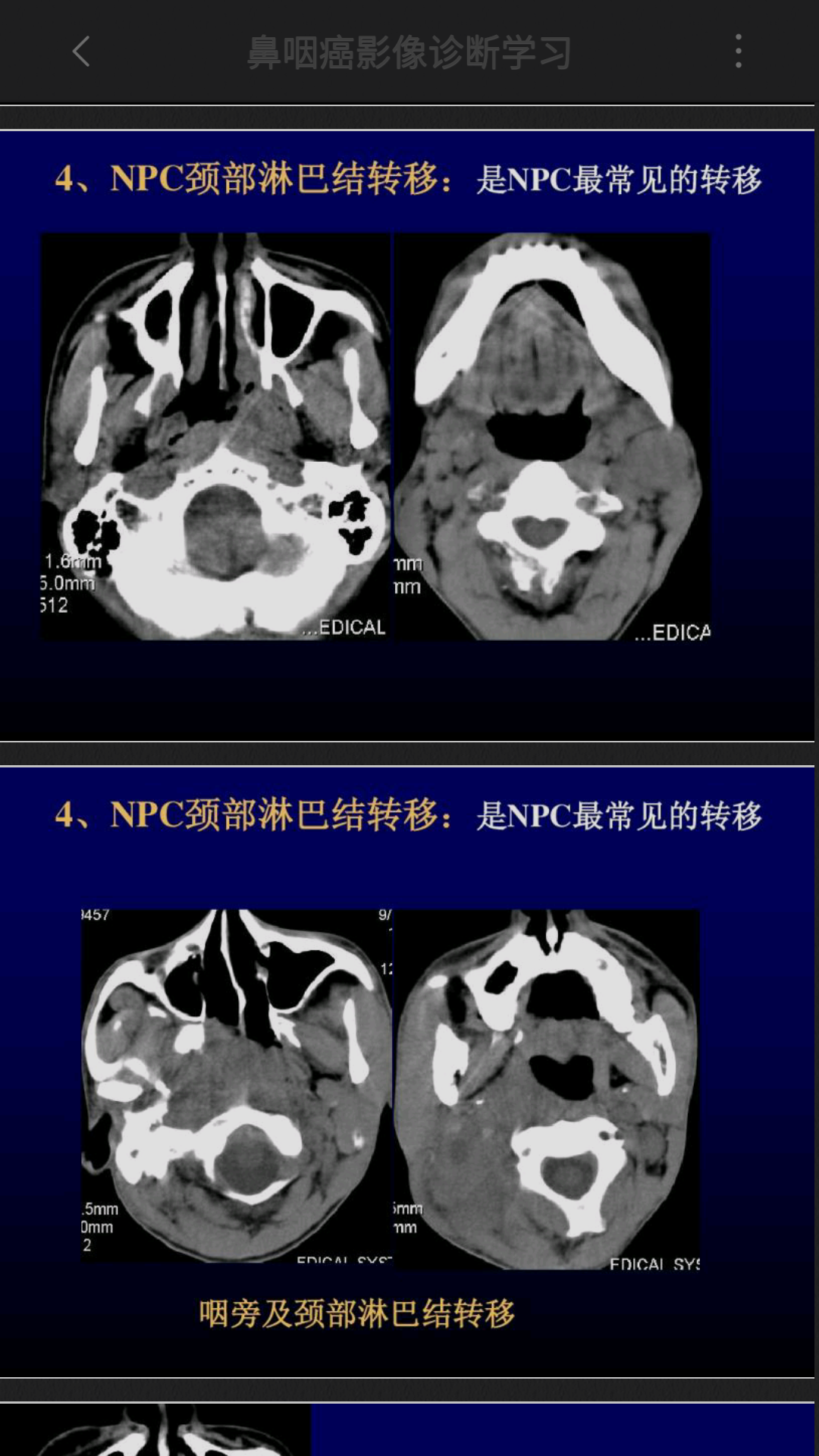 鼻咽ct.mri表现