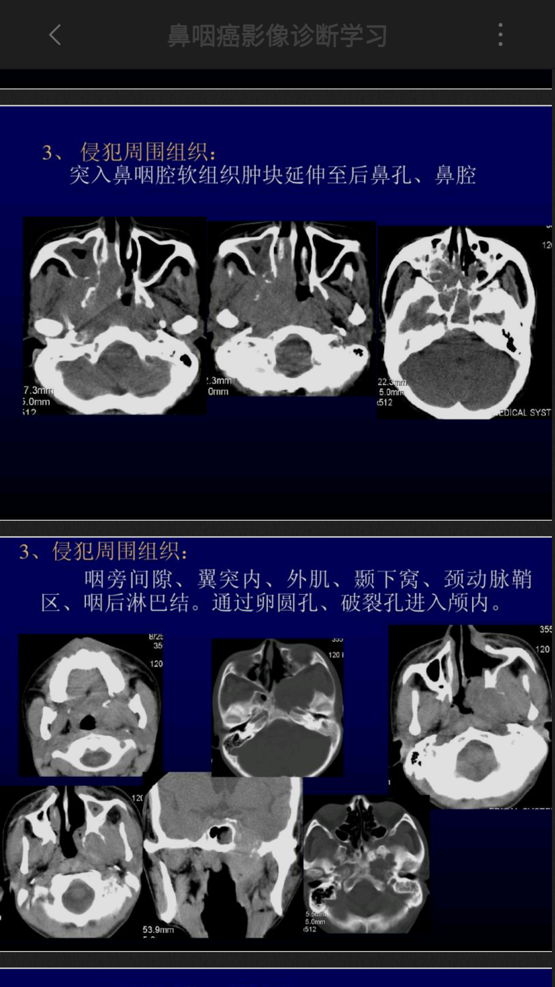 鼻咽ct.mri表现