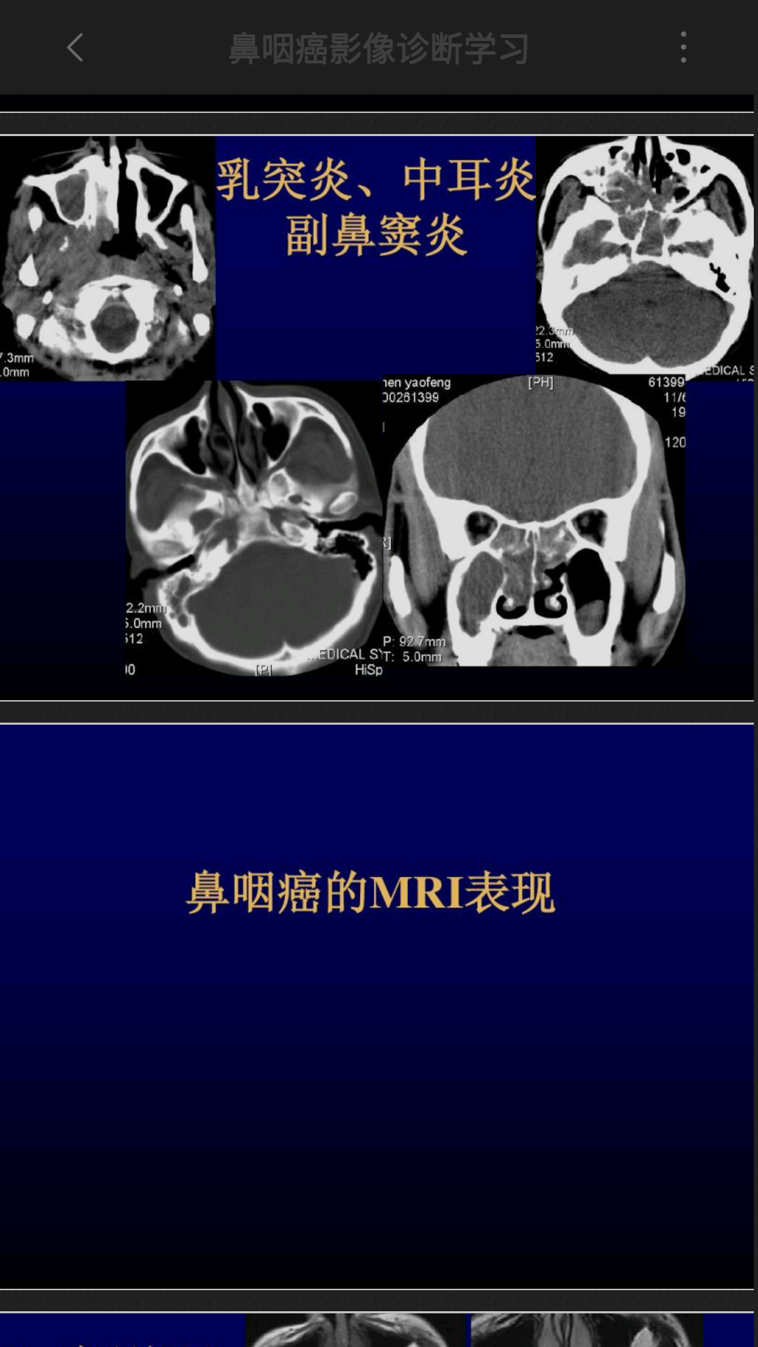 鼻咽ct.mri表现