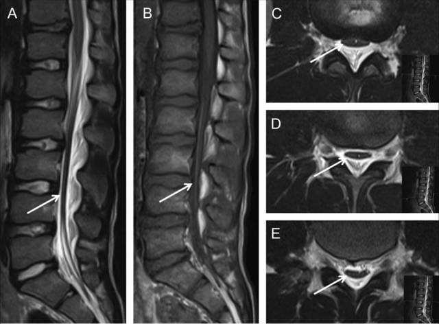 3,腰骶部mri mri是诊断脊髓栓系综合征的最佳手段,已为众多学者认可.