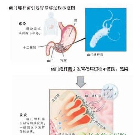 幽门螺杆菌症状_幽门螺杆菌如何根治