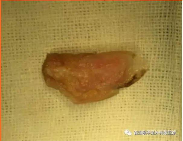甲床再植
