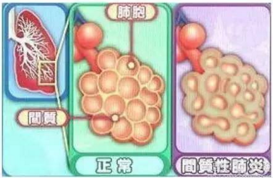 硬皮病\/系统性硬化临床表现及受累器官_好大夫