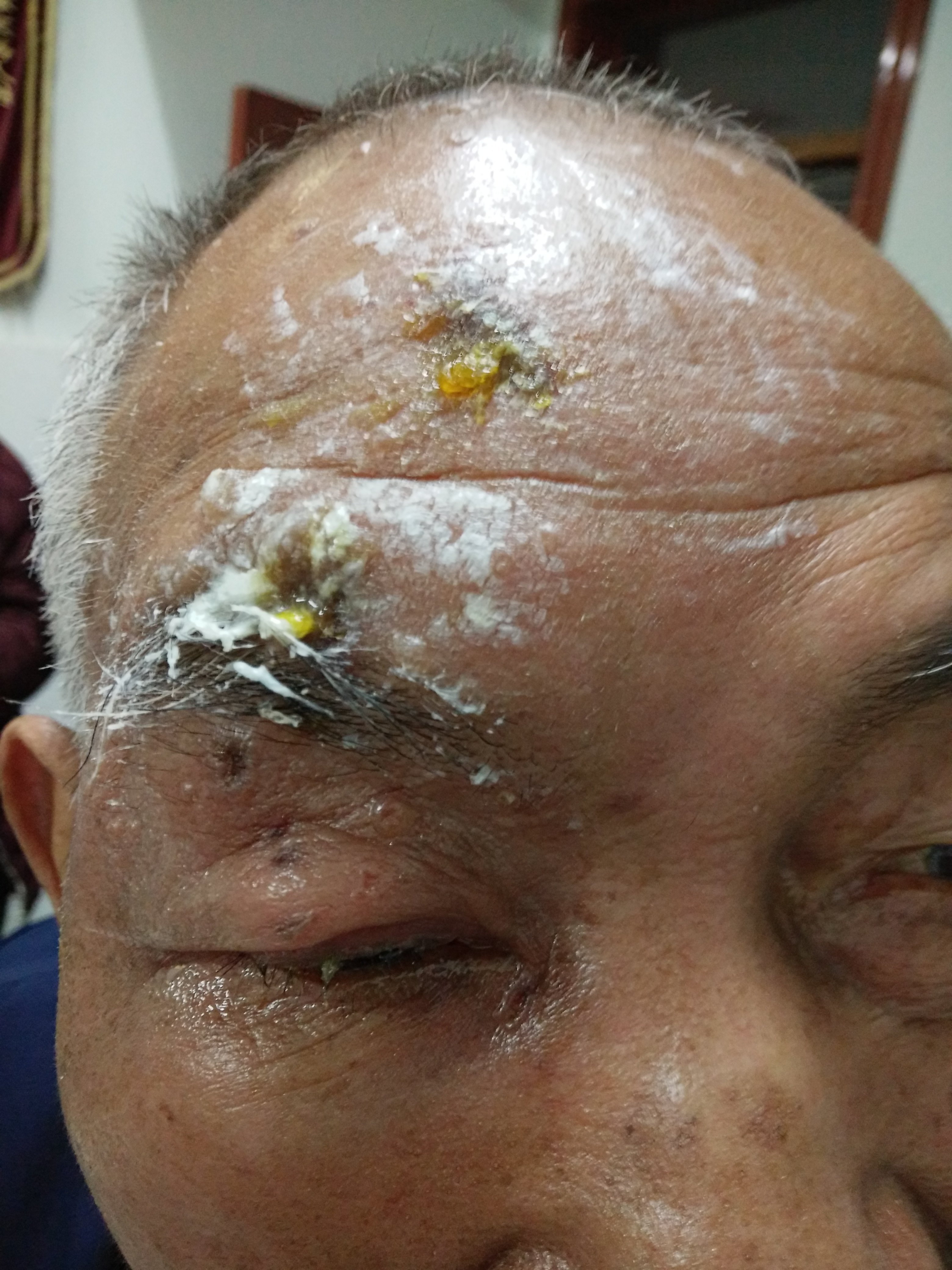眼睑带状疱疹及引起的病毒性角膜炎的经验治疗.