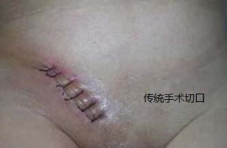 小儿腹股沟斜疝科普 - 好大夫在线