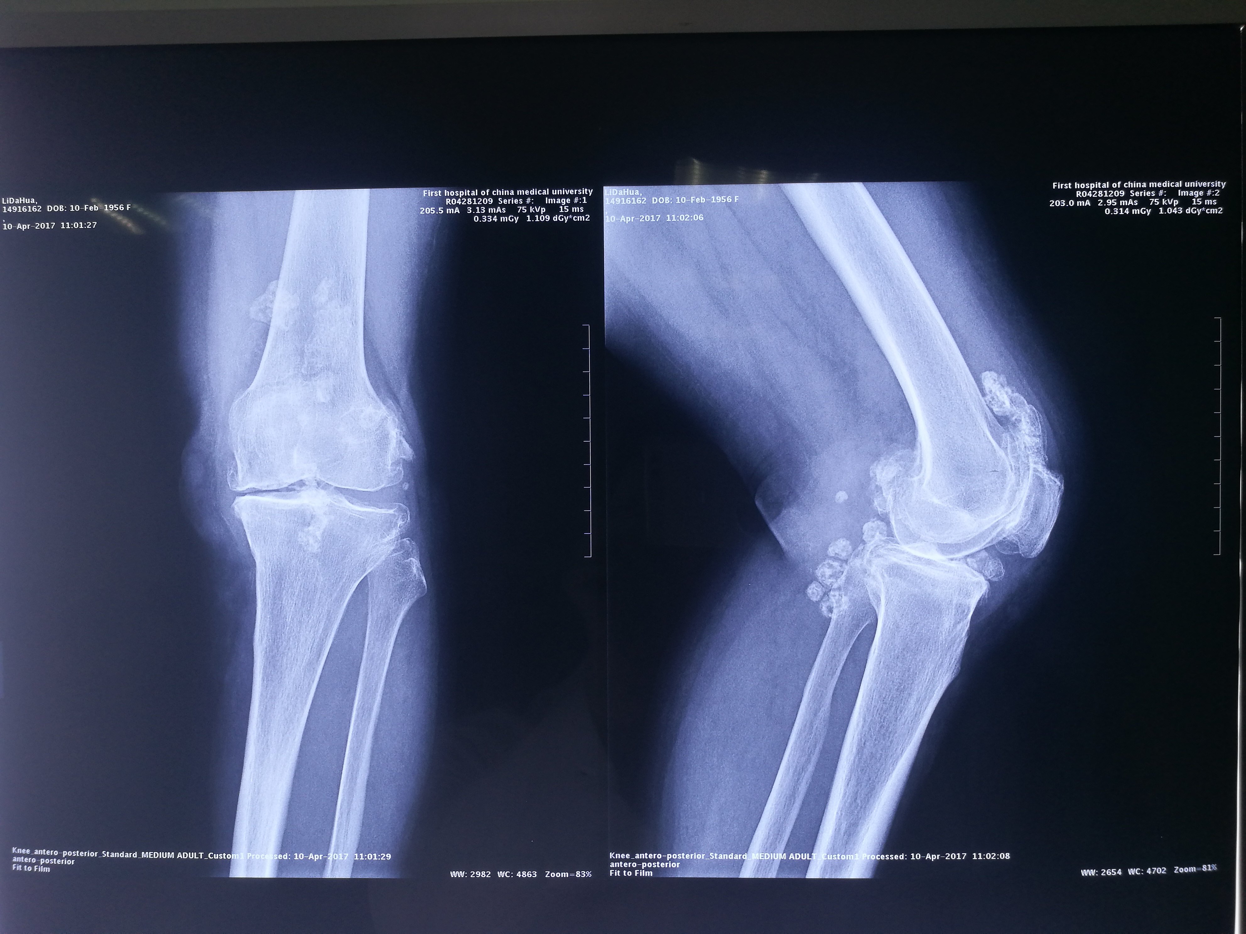 61岁女性膝关节滑膜软骨瘤病关节炎全膝关节置换术