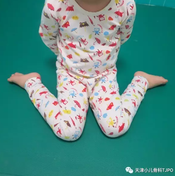 答"在走路时单侧或双侧下肢内旋,足尖向内