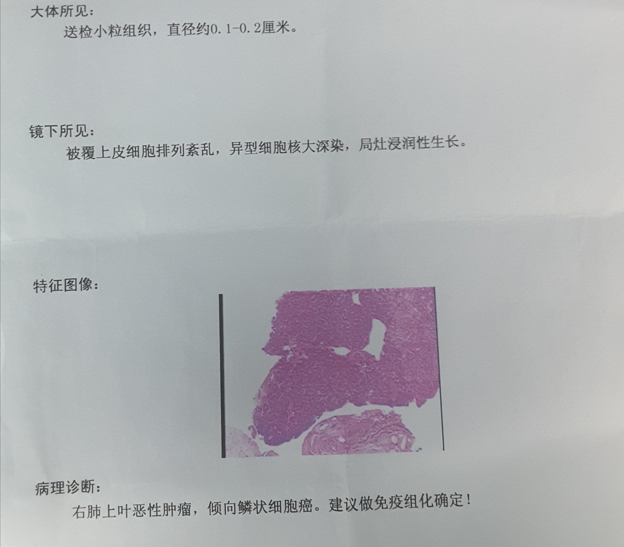 刘懿博士说肺癌(四九三)为何他需做支气管袖式肺叶切除术?