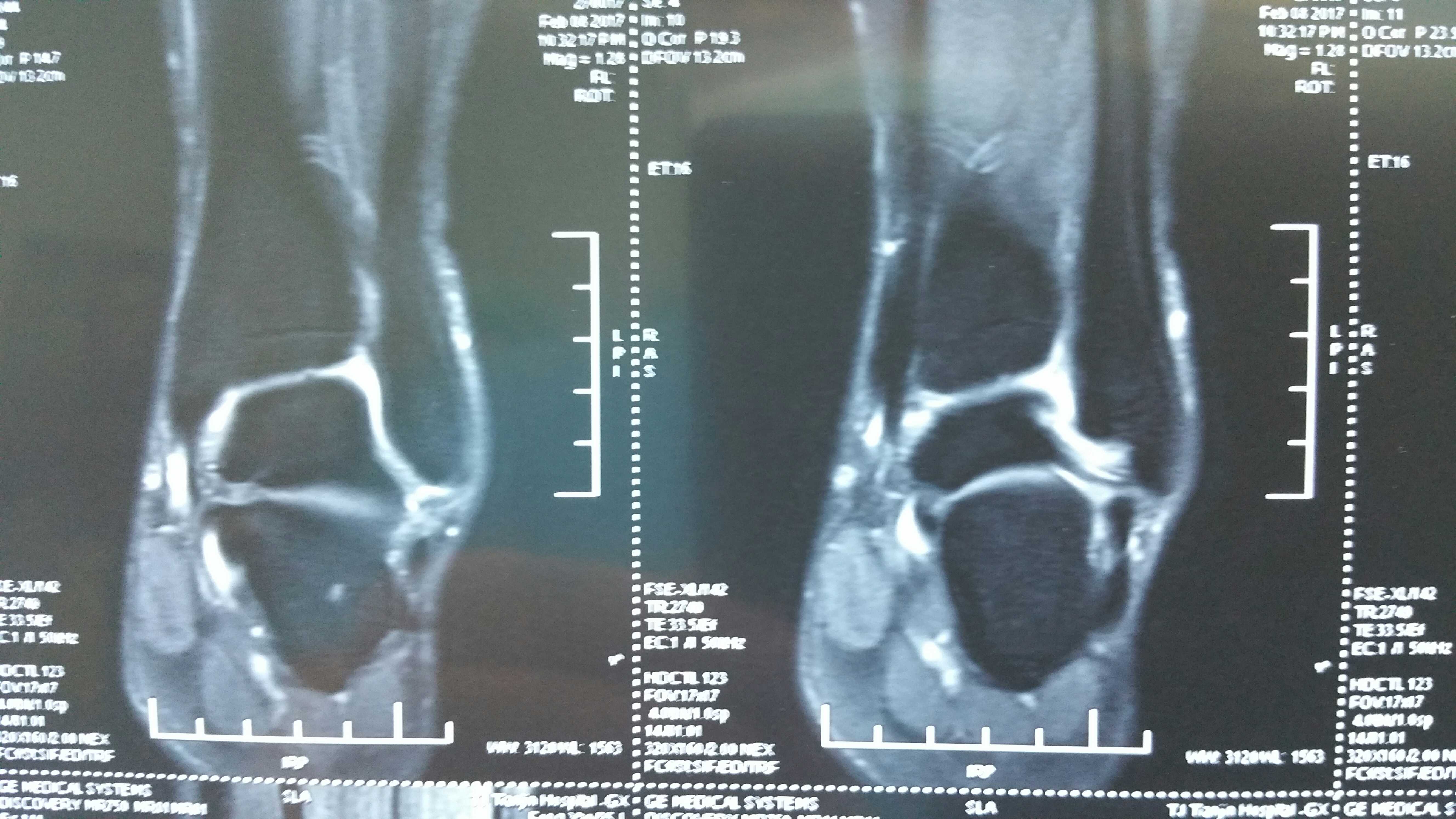 mri 检查对于踝关节韧带损伤和软骨损伤有较高的特异性