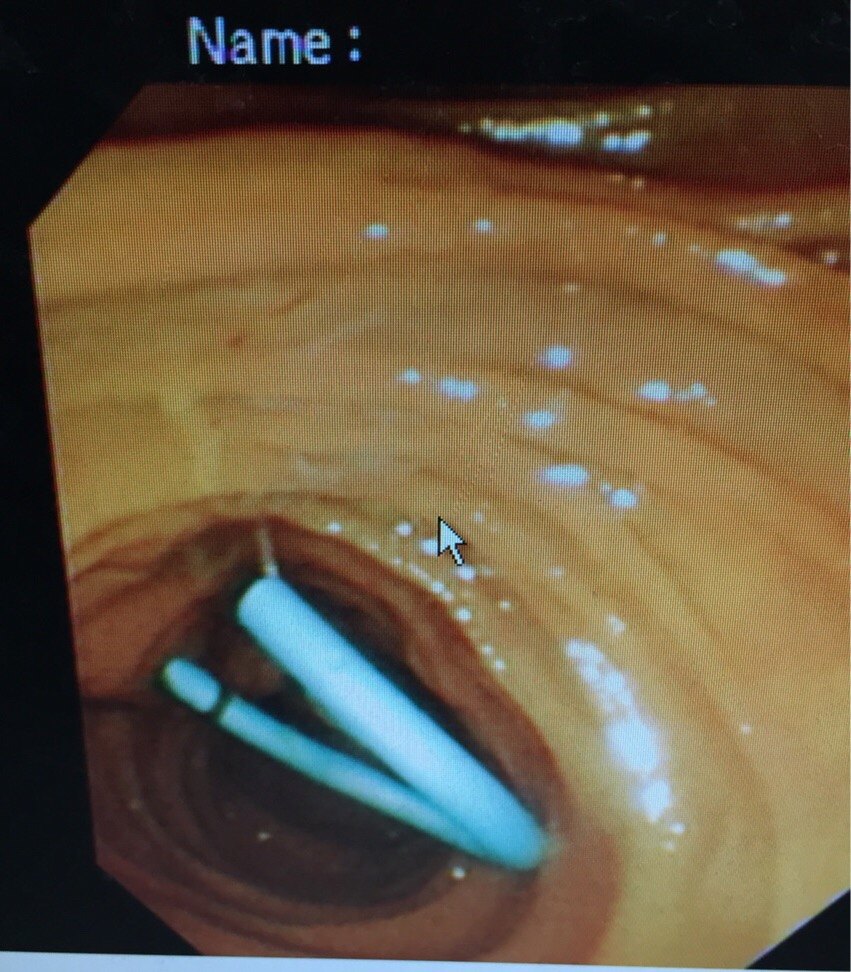 胆管造影术(endoscopic retrograde cholangiopancreatography, ercp)