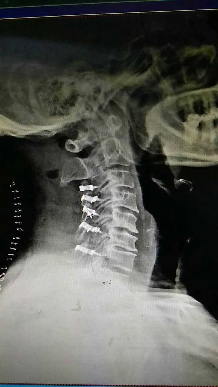 颈椎后路单开门手术 微型钛板固定优势多_好大