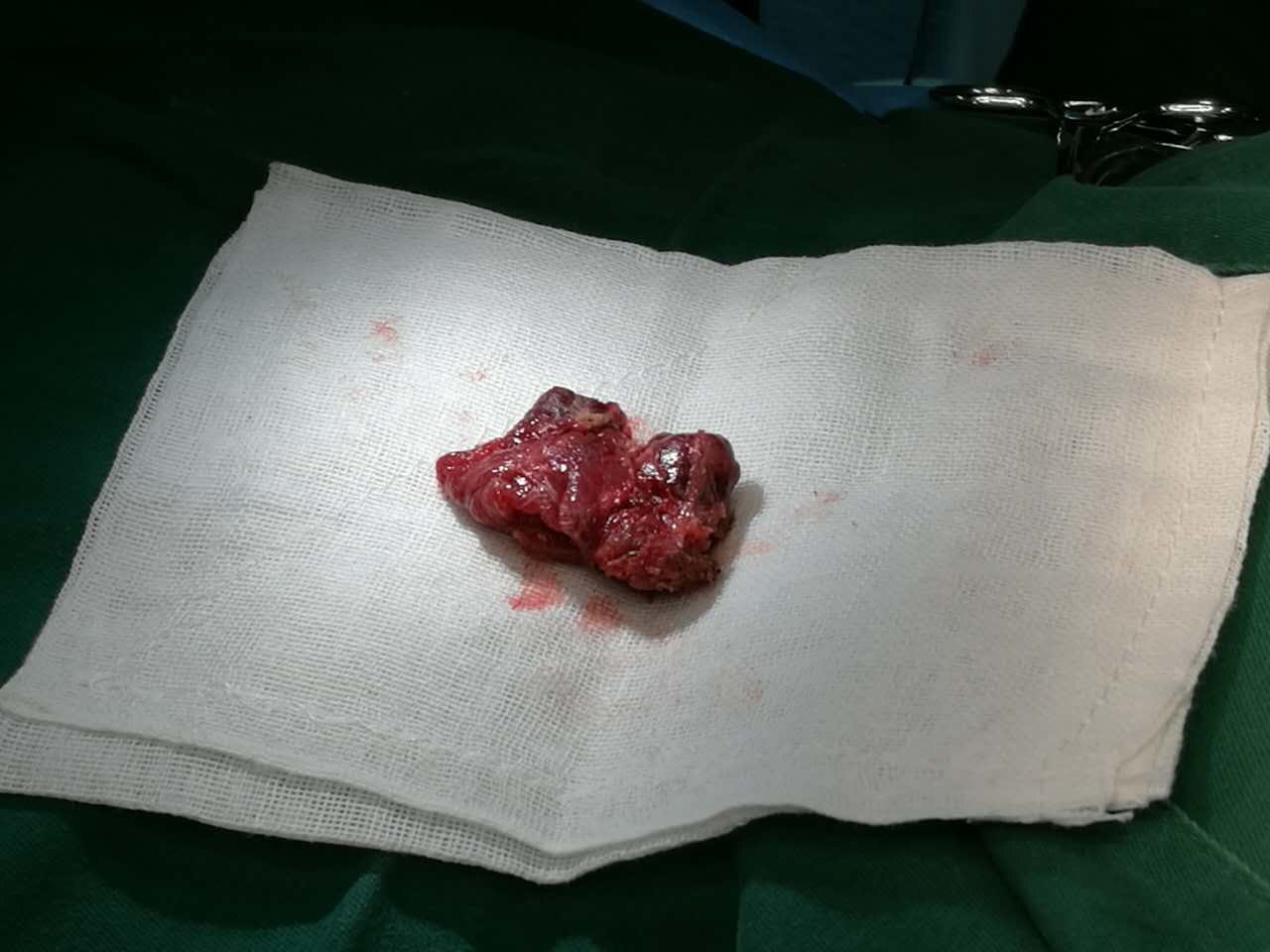 腔镜,甲状腺微创手术的新选择