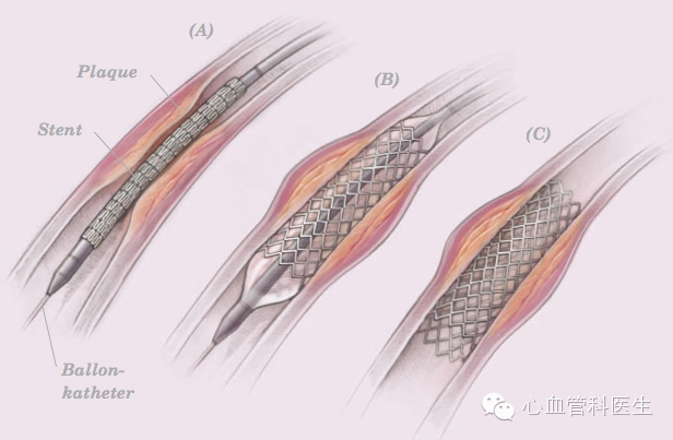 心脏支架手术那些事2:支架是异物对身体有影响