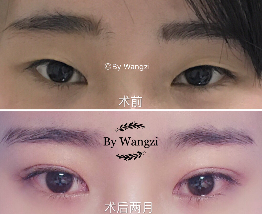 双眼皮开眼角术前术后对比照片