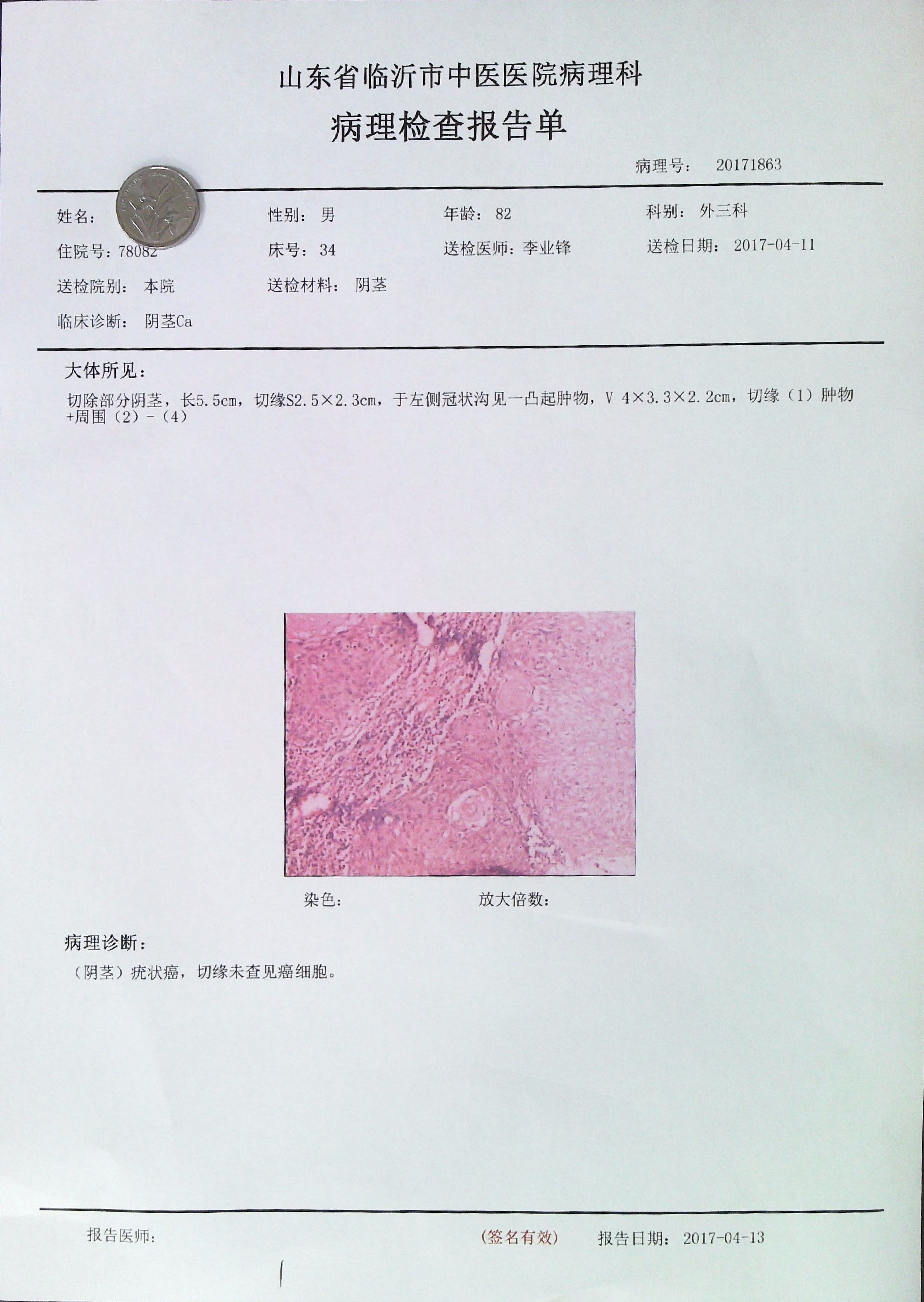 阴茎疣状癌