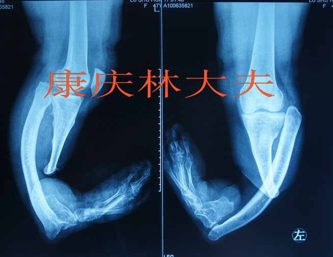胫侧半肢畸形矫正先天性胫骨缺如的治疗典型病例