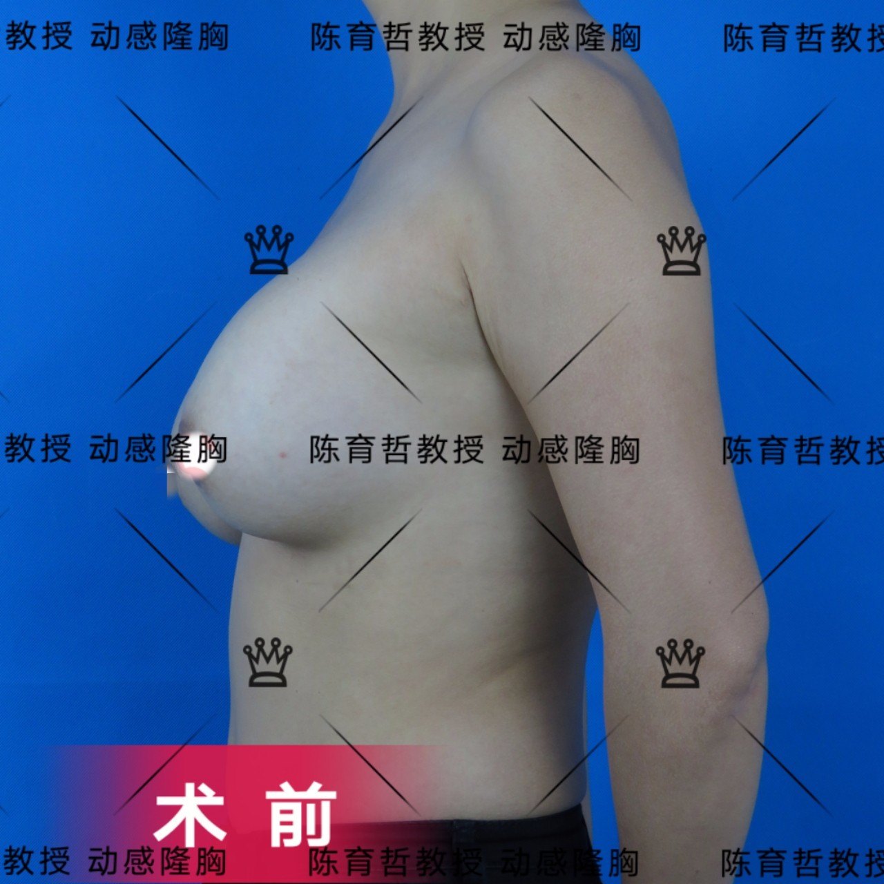 动感隆胸案例(36)注射物取出再植入假体的包膜