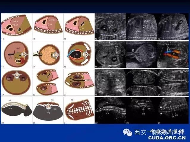 帮助孕妈妈了解胎儿系统性超声筛查作用
