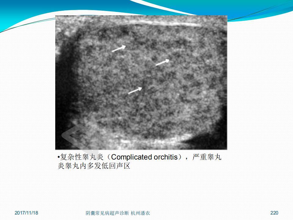 阴囊常见病超声诊断之二