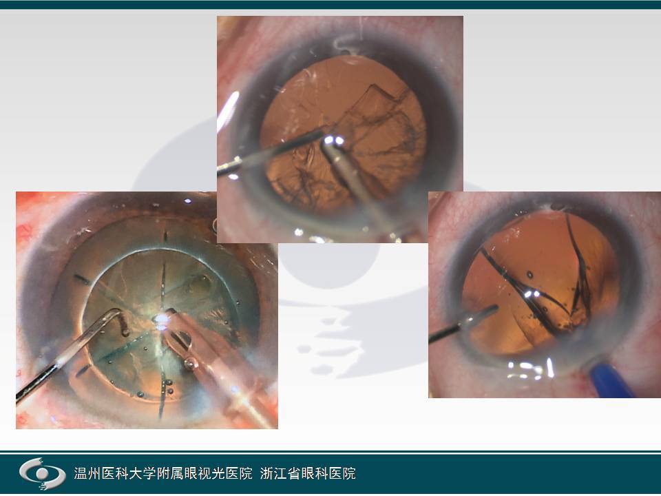 白内障手术方式介绍超声乳化手术深入版