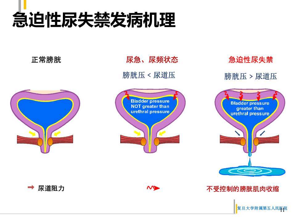 中老年妇女的难言之隐尿失禁